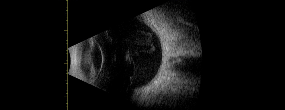 Echographie mode B